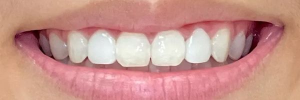 Close-up of a smiling mouth with straight, white teeth. Pink lips are slightly parted.