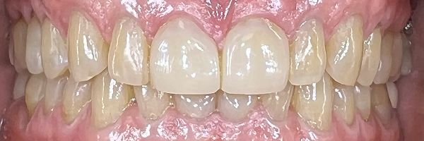 Close-up of a person's teeth. The teeth are visible, with a light cream color. The gums are pink.