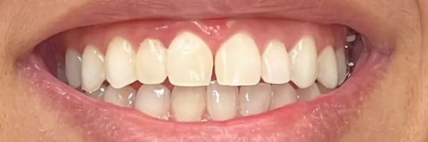 Close-up of a person's teeth, showing a smile. The teeth are white with a small gap in the front.