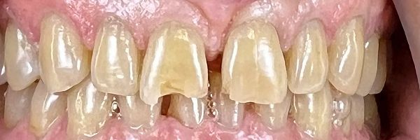 Close-up of teeth with yellowish color. The center tooth is chipped.