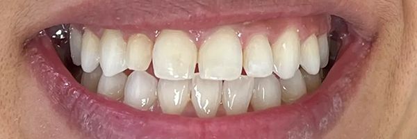 Close-up of a person's teeth. They are white and well-aligned within the lips, which are slightly parted.