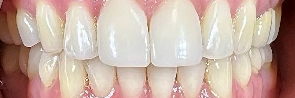 Close-up of human teeth, showing a row of white upper and lower teeth, with pink gums.