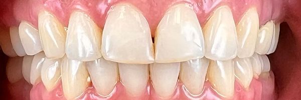 Close-up of human teeth, with focus on the front row. The teeth are white with a slight yellow tint, and surrounded by pink gums.