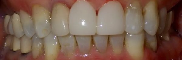 Close-up of teeth. The two center teeth appear bright white. Other teeth have a yellowish tint. The gums are pink.
