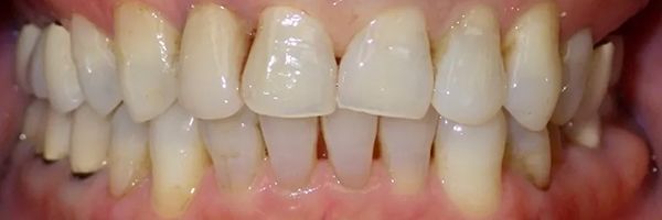 Close-up of a person's teeth. The teeth are yellow and slightly misaligned. The gums are pink.