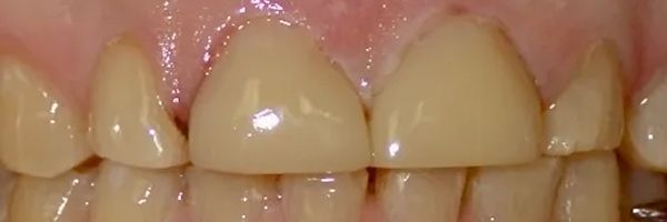 Close-up of human teeth, showing a central pair of teeth that appear to be capped. Other teeth appear natural.