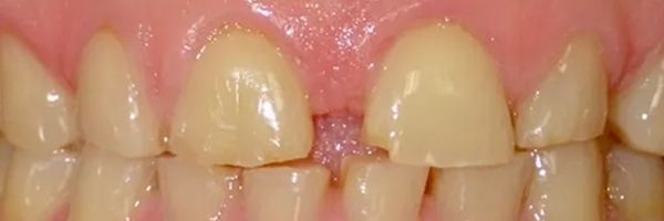 Close-up of teeth; front teeth are discolored and have a gap between them.