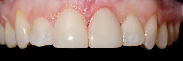 Close-up of a person's upper teeth, showing white, healthy teeth and pink gums against a black background.