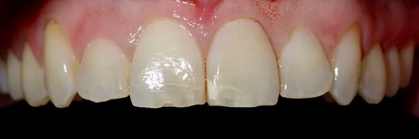 Close-up of human teeth, pale color, some teeth chipped. Pink gums visible.