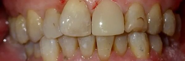 Close-up of a person's teeth, showing yellowed teeth with some staining and minor imperfections.