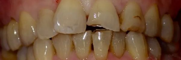 Close-up of teeth, some with decay and damage.