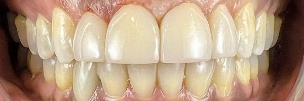 Close-up of a person's teeth, showing the upper and lower rows. The teeth are a shade of off-white.