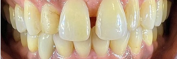Close-up of teeth. The teeth are yellowed, and the gums are pink.