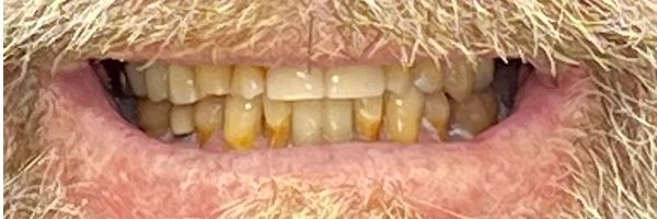 Close-up of a person's mouth with yellowed teeth and a beard.