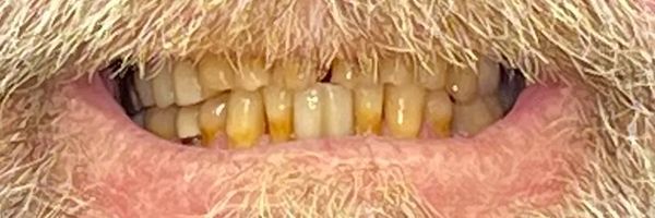 Close-up of a person's mouth with yellowed teeth and a beard.