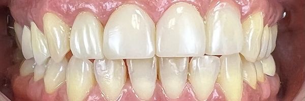Close-up of teeth with a bright, white color. Gum tissue visible with slight redness.