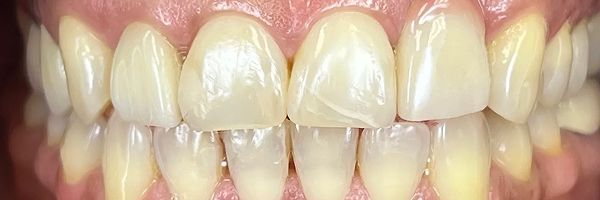 Close-up of human teeth, showing the upper and lower arches. Teeth are a light yellowish-white.