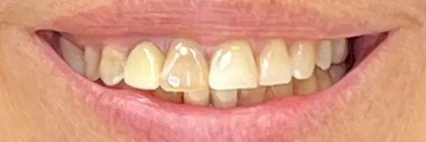 Close-up of a person's smiling mouth showing teeth. The teeth are slightly yellow.