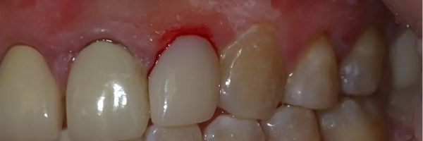 Close-up of human teeth, varying shades of white and yellow. Gums visible, in a mouth.