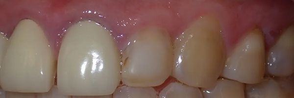 Close-up view of teeth, some with crowns. Gums are slightly red, teeth are generally white with some yellowing towards the back.