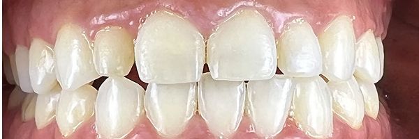 Close-up of human teeth, showing a row of white teeth with pink gums.