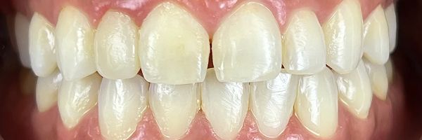 Close-up of human teeth, showing a row of white, healthy teeth with gum tissue.