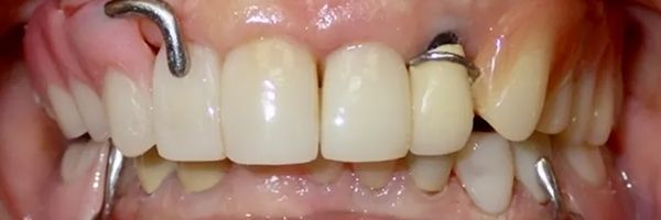 Close-up of a person's upper teeth. Partial dentures are held in place by metal clasps.
