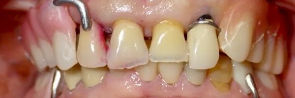 Close-up of teeth with dental tools, showing inflamed gums. Some teeth are discolored and have crowns.