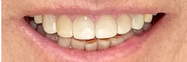 Close-up of a person's smiling mouth showing teeth. The upper teeth are a light color; the lower teeth are darker.
