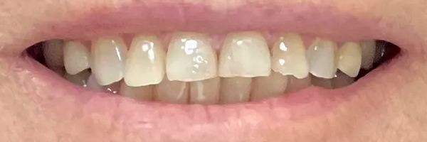 Close-up of a person's teeth, showing slight discoloration, with a visible mouth.