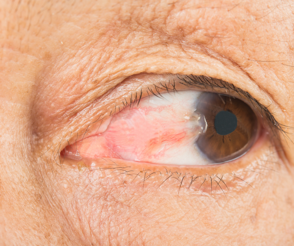 FLOATERS | South Shore Eye Care | Service Page FLOATERS | South Shore Eye Care | Service Page