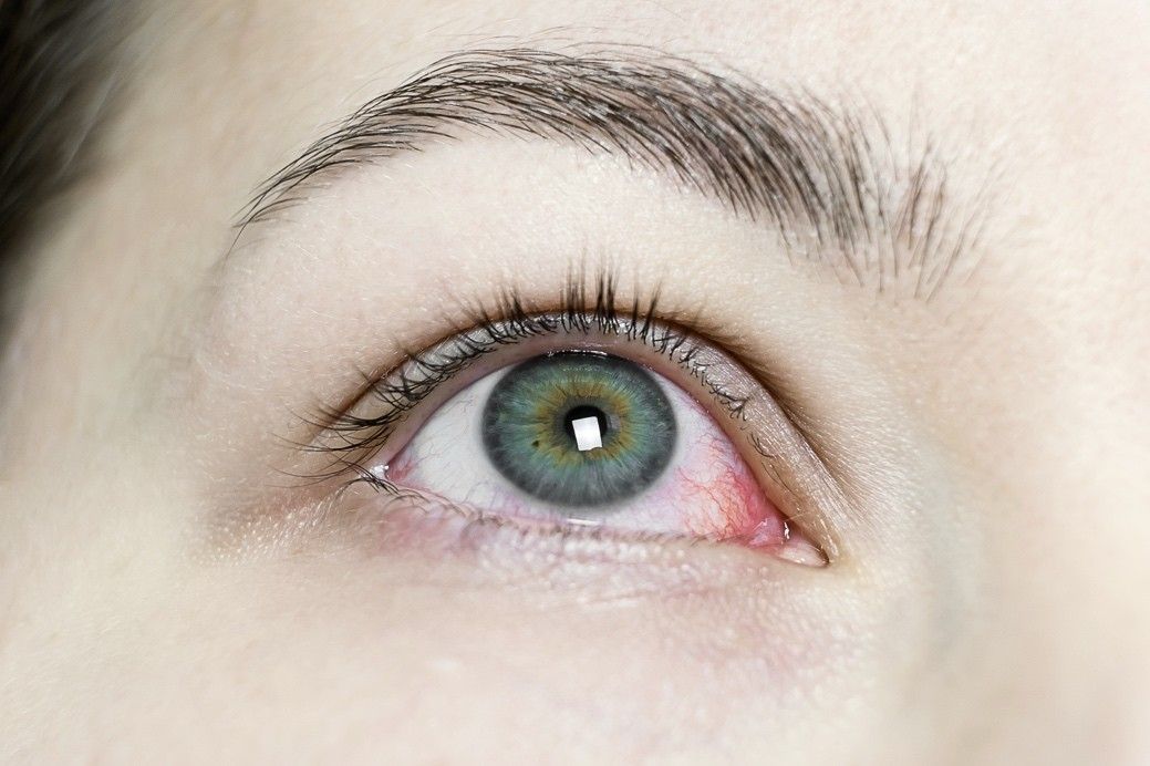 Allergic Conjunctivitis vs. Viral/Bacterial Pink Eye: How to Tell the Difference
