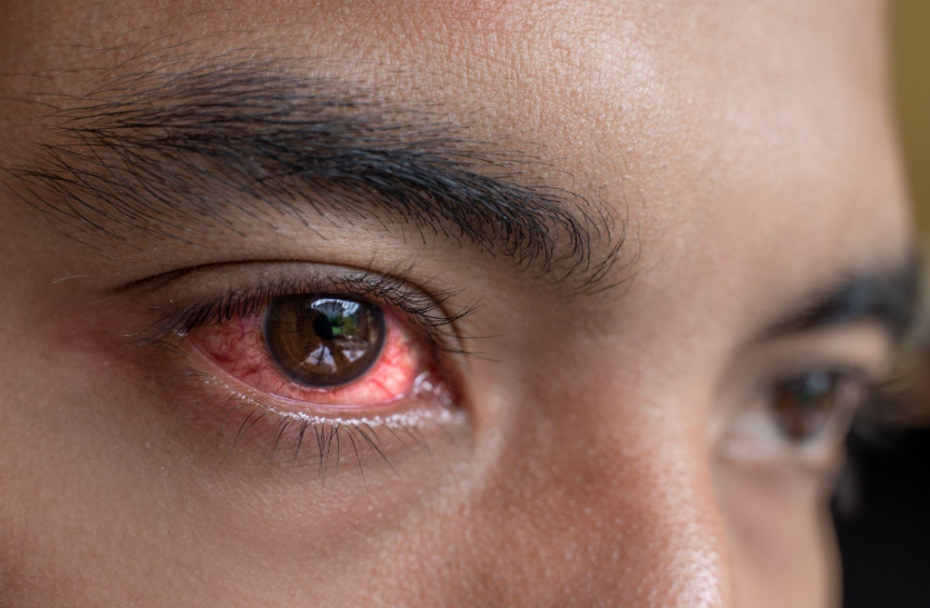 Recognizing and Treating Herpes Simplex Keratitis in the Eyes | South Shore Eye Care, LLP