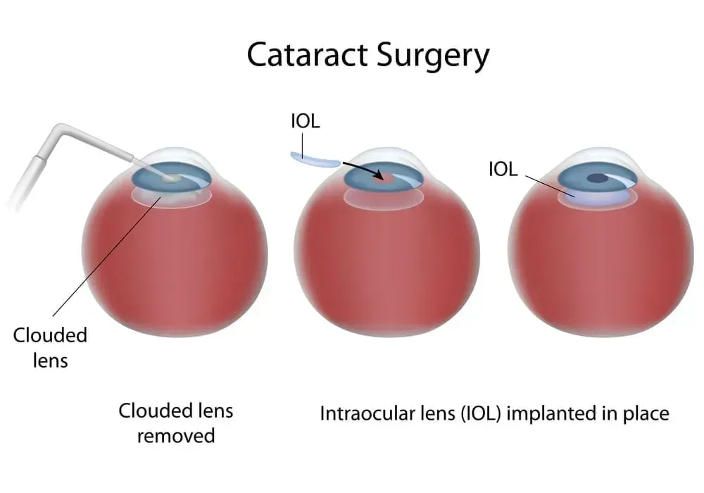 FEMTO LASER CATARACT SURGERY | South Shore Eye Care | Service Page FEMTO LASER CATARACT SURGERY | South Shore Eye Care | Service Page
