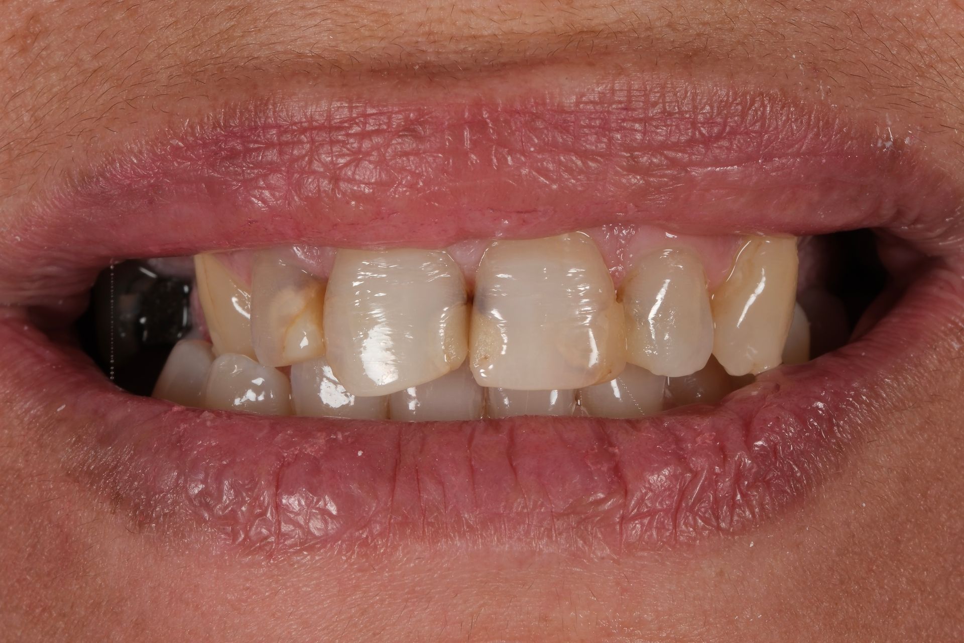 A close up of a person 's mouth showing their teeth.