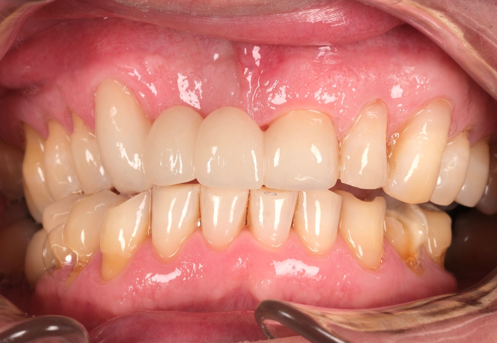 A close up of a person 's mouth with a lot of teeth.