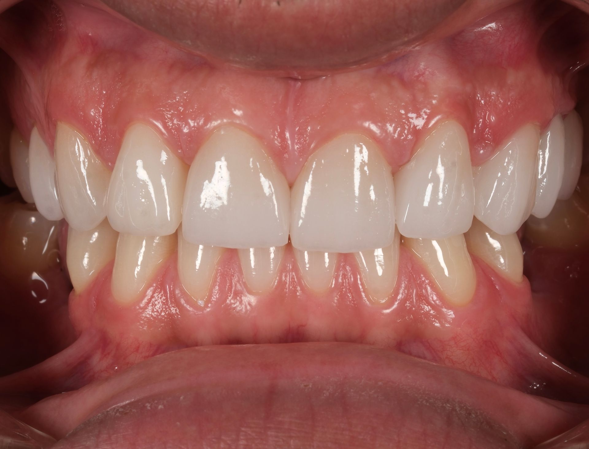 A close up of a person 's teeth with white teeth.