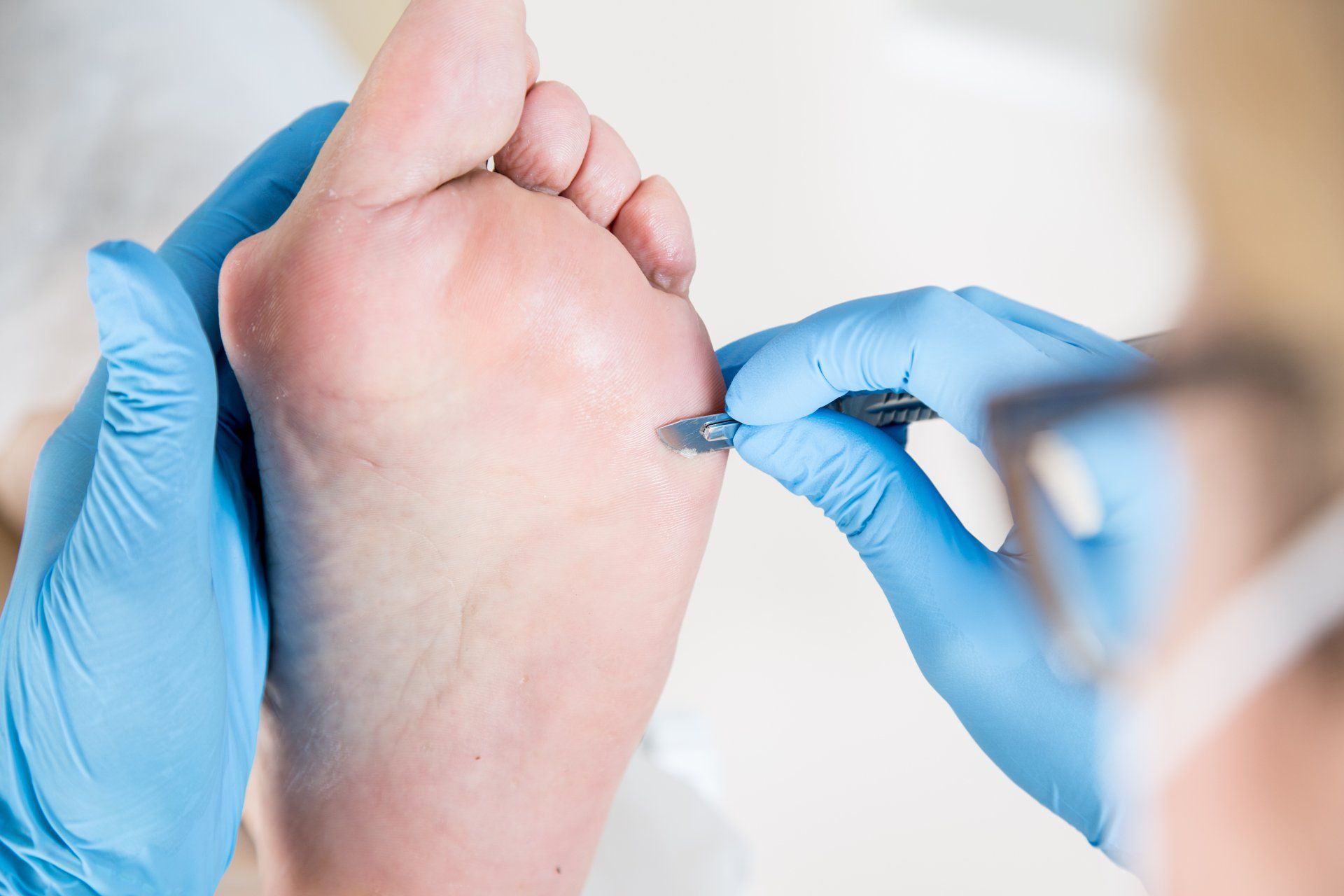 Verrucas Treatment