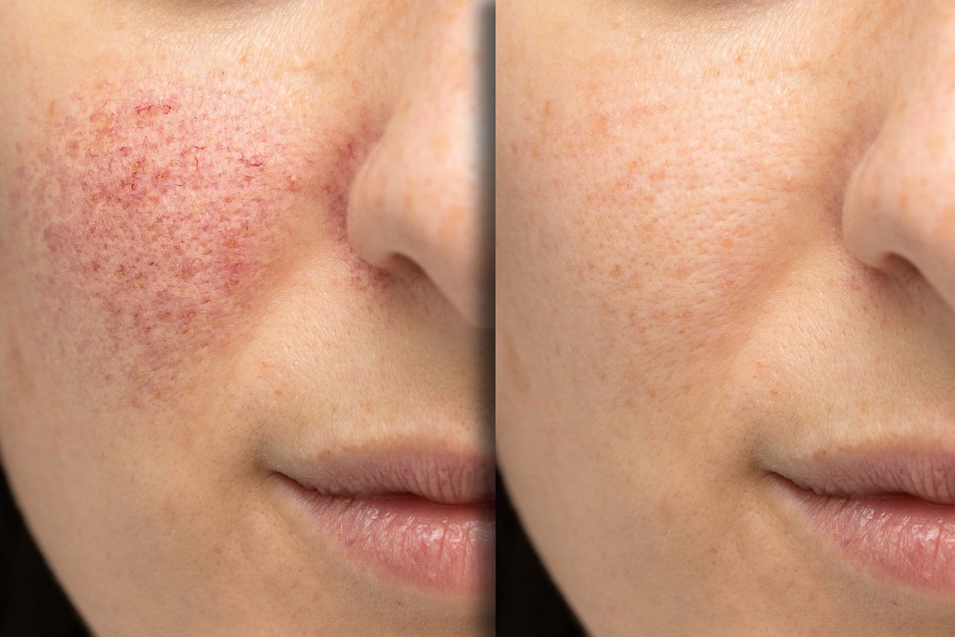 A before and after photo of a woman 's face with red spots.
