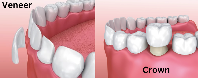 A close up of a man 's teeth next to a tooth color chart.