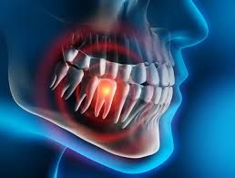 An x-ray of a person 's teeth with a tooth missing.