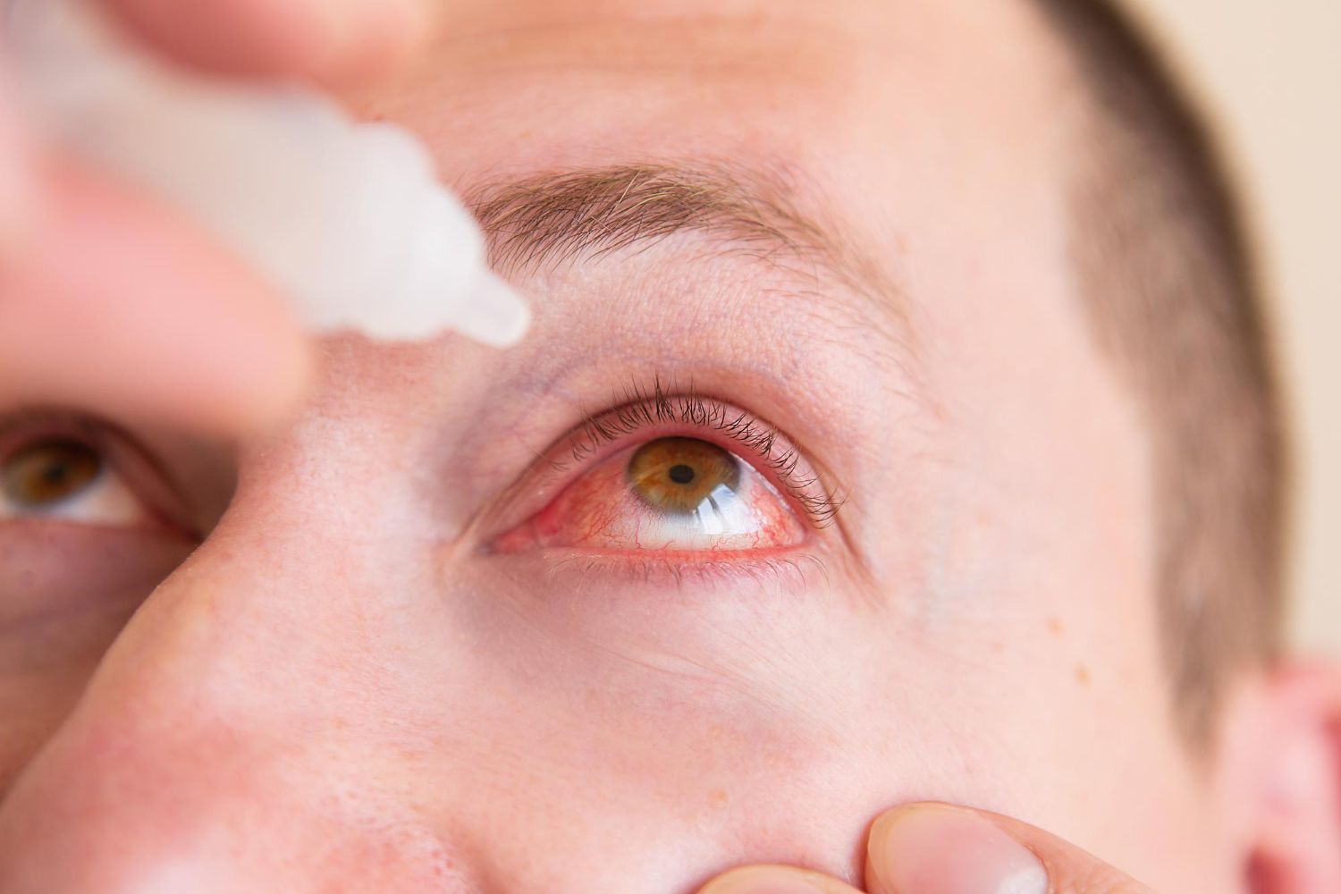 Sensation de sable dans les yeux, brûlures, larmoiement ? Découvrez les causes de la sécheresse oculaire, les traitements efficaces et quand consulter un ophtalmologue à Saint-Jean-de-Védas.