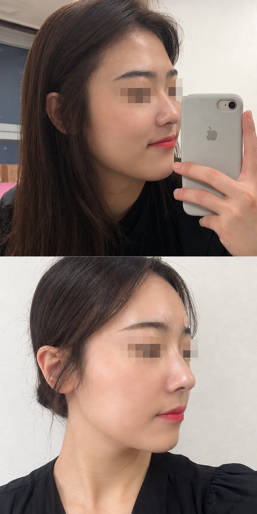 Before and after nose filler and skin glow at The Boom Dermatology, a skin clinic in Busan Seomyeon, case 1
