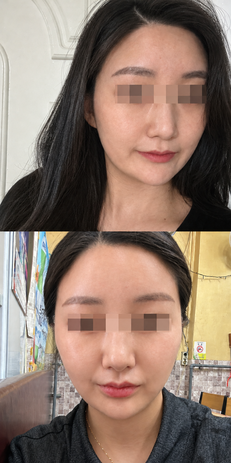 Before and after thread lift and skin booster at The Boom Dermatology, a skin clinic in Busan Seomyeon, case 2