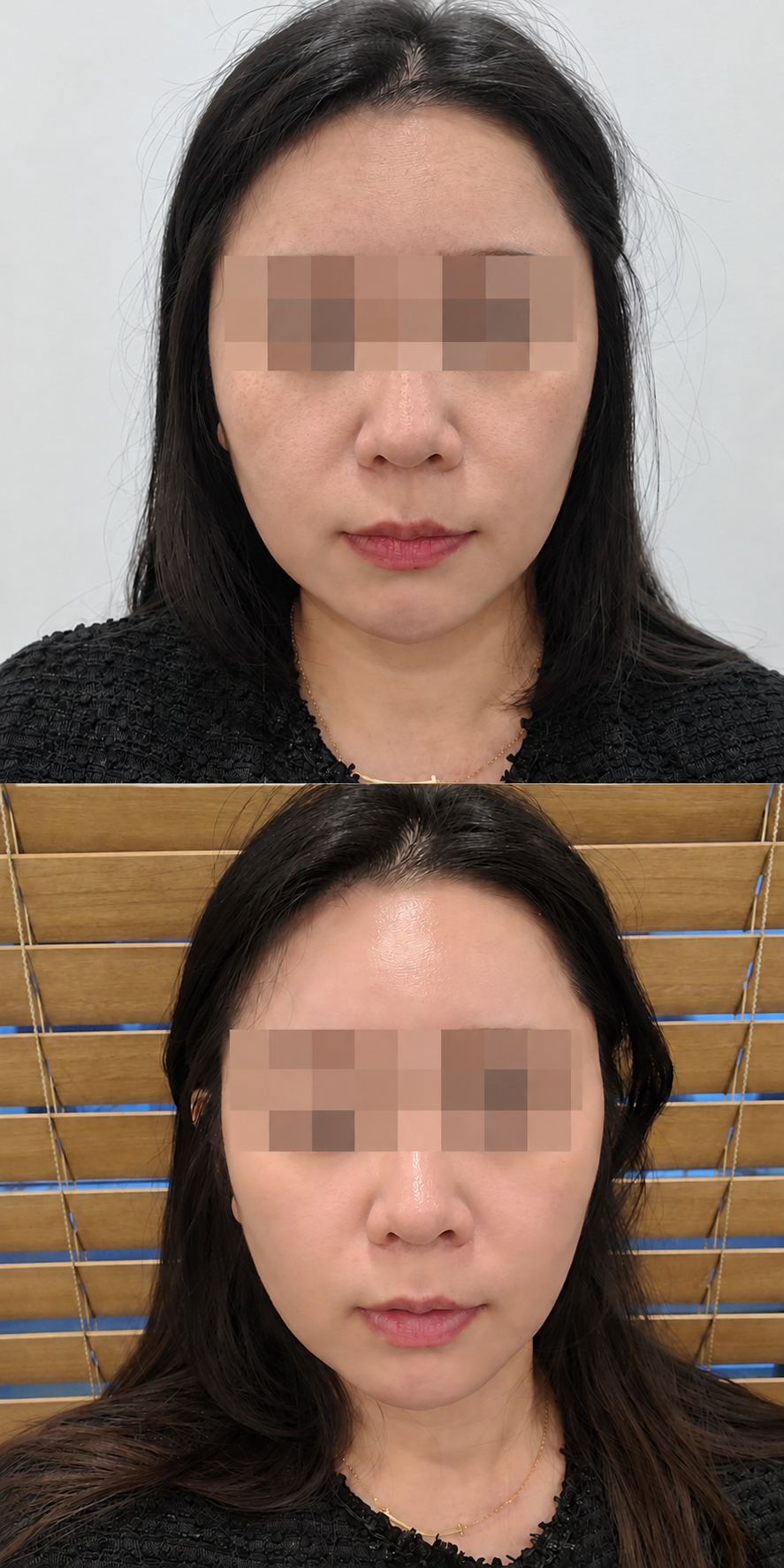 Before and after ultherapy and tone at The Boom Dermatology, a skin clinic in Busan Seomyeon, case 3