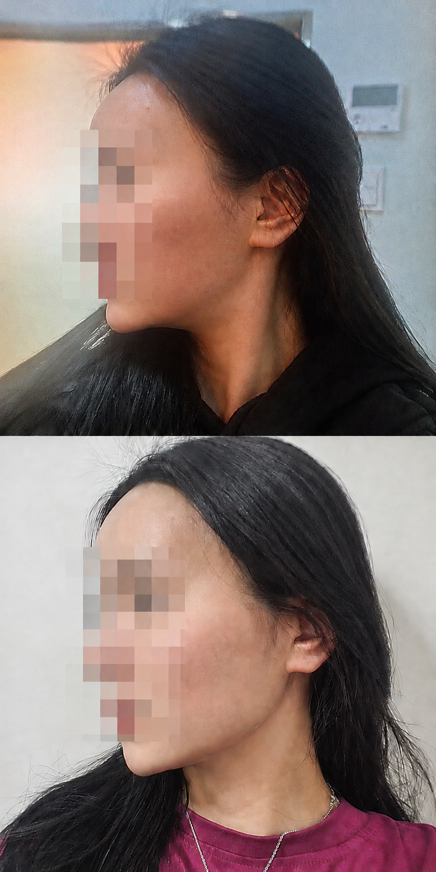 Before and after double chin thread and jawline at The Boom Dermatology, a skin clinic in Busan Seomyeon, case 4