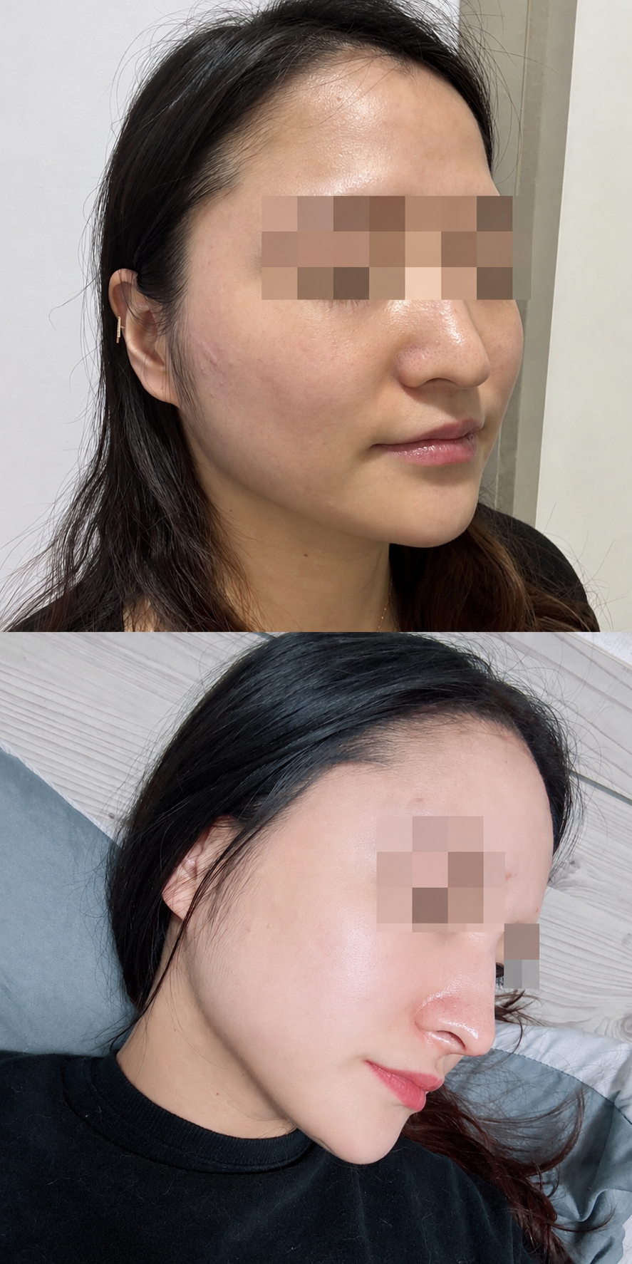 Before and after nose thread lift and glow at The Boom Dermatology, a skin clinic in Busan Seomyeon, case 5