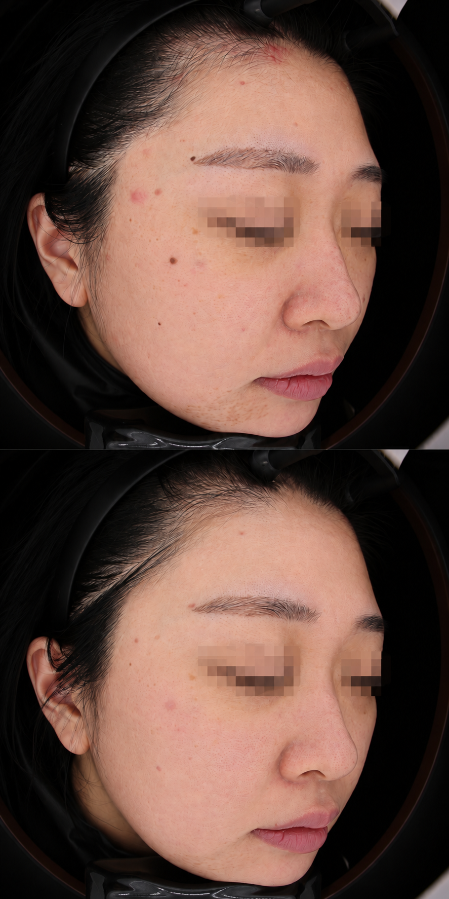 Before and after acne and dark spots at The Boom Dermatology, a skin clinic in Busan Seomyeon, case 6