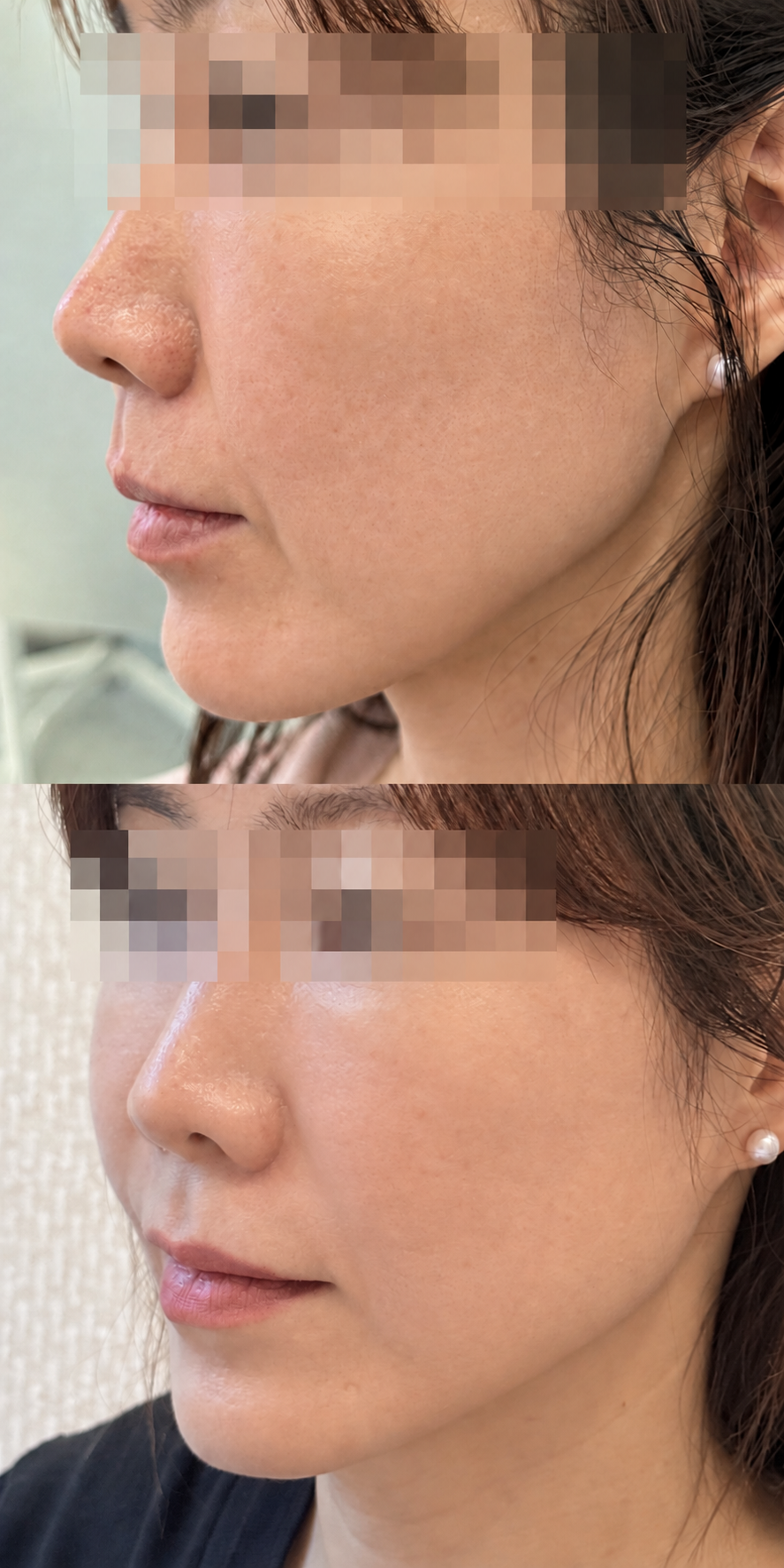 Before and after xerf lifting and tone at The Boom Dermatology, a skin clinic in Busan Seomyeon, case 7