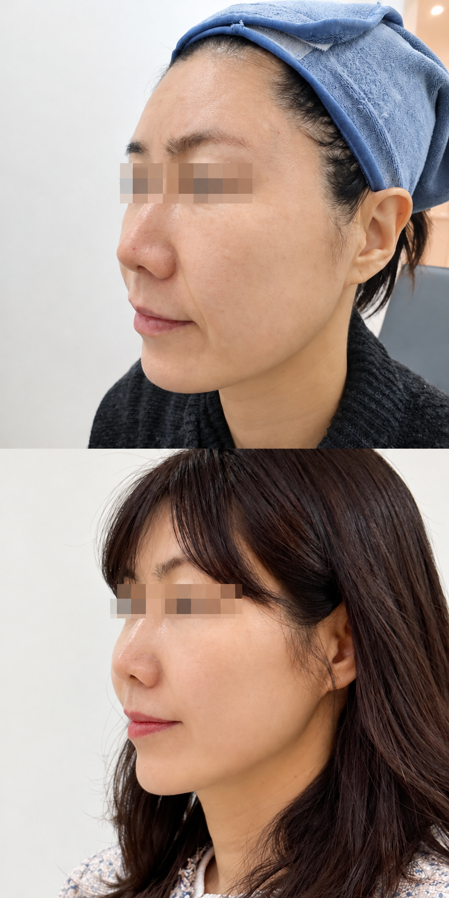 Before and after aptos thread lift and texture at The Boom Dermatology, a skin clinic in Busan Seomyeon, case 8